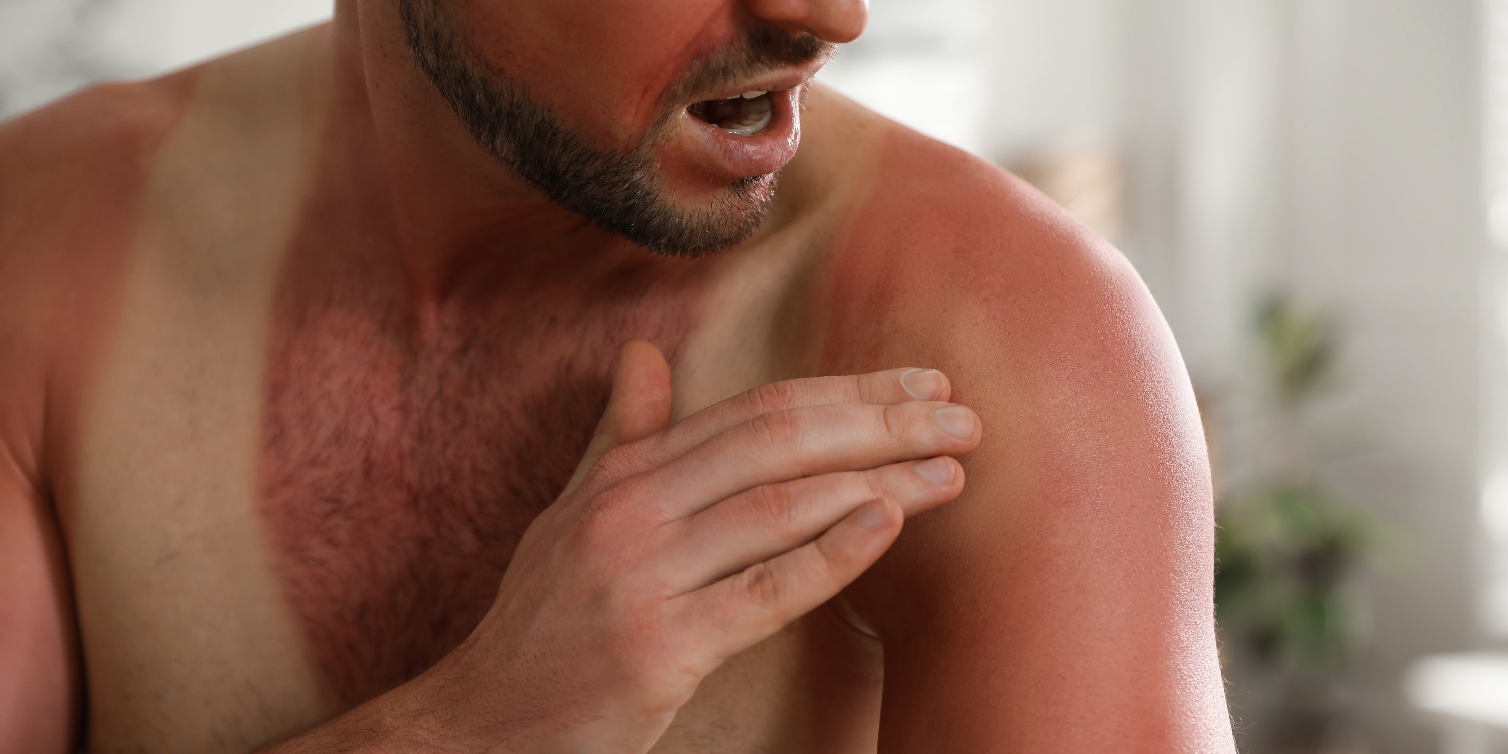 Soothing Sunburns: How Hemp Skincare Offers Relief and Healing